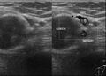 Axillary nerve sheath tumor (Radiopaedia 12201-12526 A 1).jpg