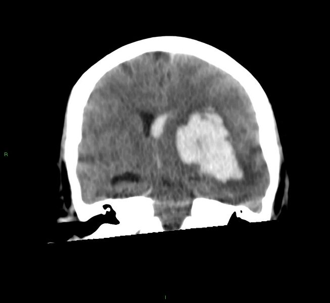 File:Basal ganglia hemorrhage (Radiopaedia 58759-65981 Coronal non-contrast 39).jpg