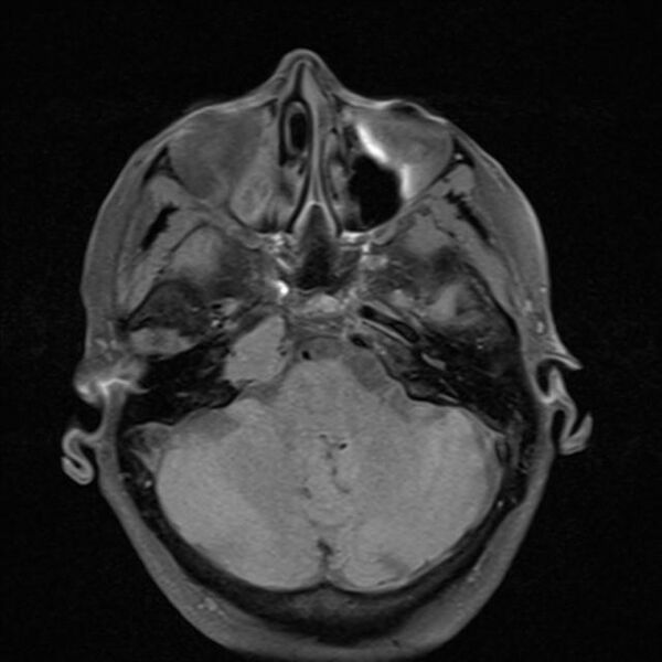 File:Base of skull chondrosarcoma (Radiopaedia 30410-31070 Axial T1 fat sat 8).jpg