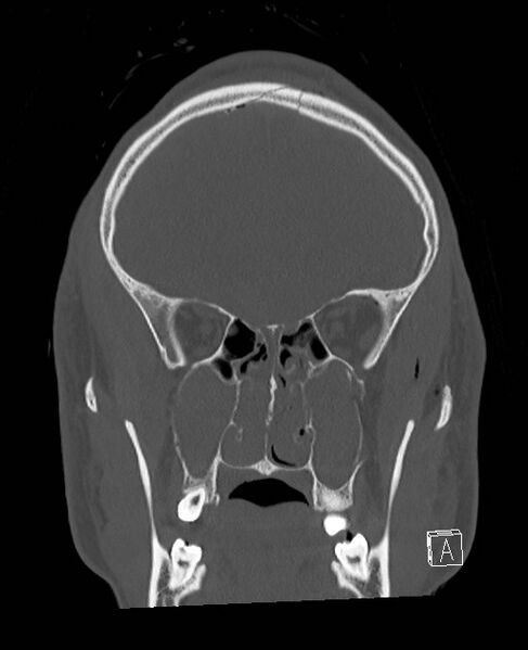 File:Base of skull fracture with bilateral Le Fort fractures (Radiopaedia 47094-51638 Coronal bone window 69).jpg