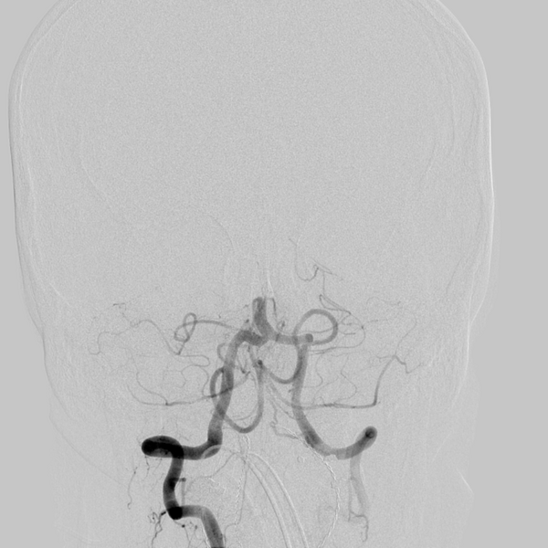 File:Basilar artery occlusion (Radiopaedia 33570-34668 RT VERT IC 14).png