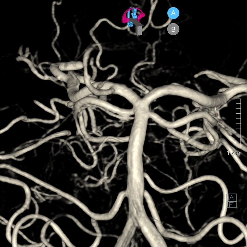 Basilar artery perforator aneurysm (Radiopaedia 82455-97734 3D view left VA 114).jpg