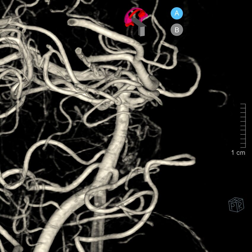 Basilar artery perforator aneurysm (Radiopaedia 82455-97734 3D view left VA 77).jpg