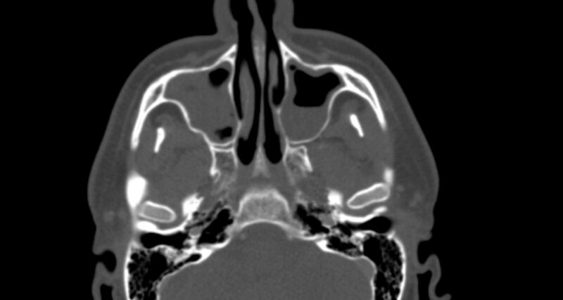 File:Benign mixed salivary tumor of the parotid gland (Radiopaedia 35261-36792 Axial bone window 9).jpg