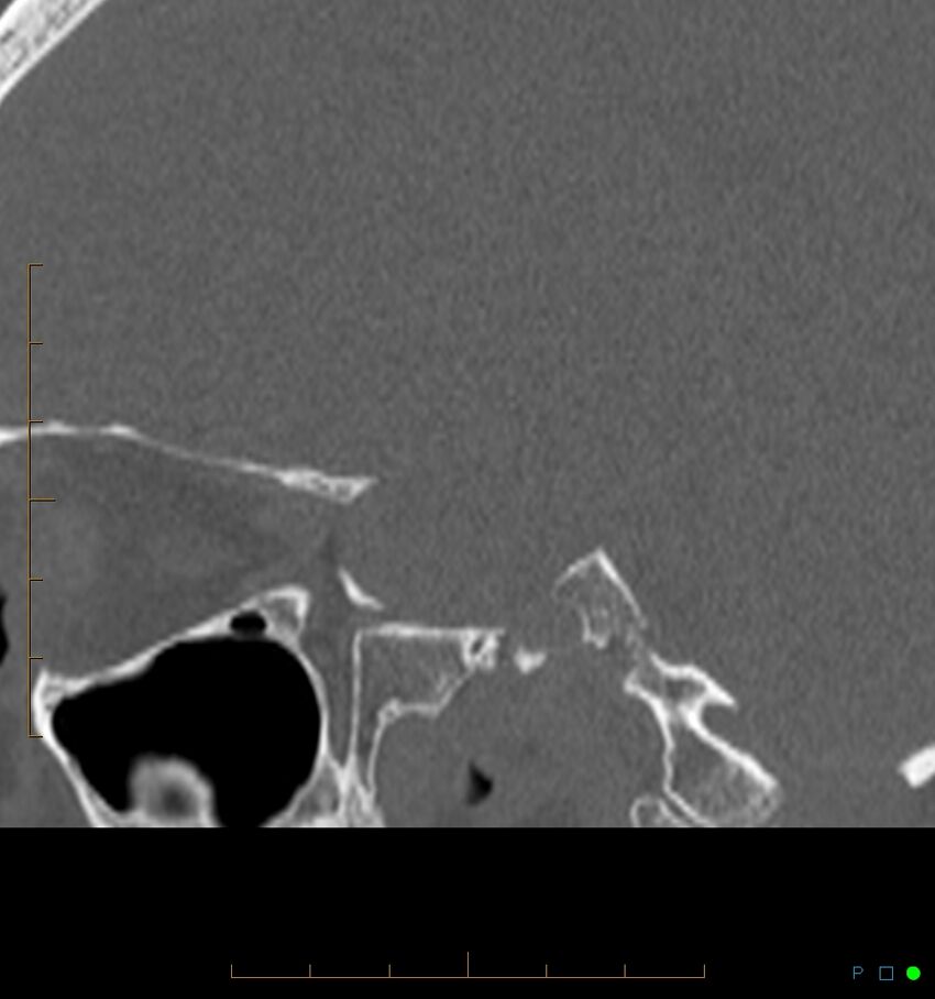 Benign notochordal cell tumor (probable) (Radiopaedia 65475-74546 Sagittal bone window 44).jpg