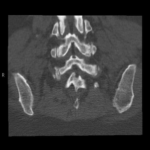 File:Bertolotti syndrome (Radiopaedia 24864-25128 Coronal bone window 40).jpg
