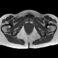 Bicornuate uterus (Radiopaedia 61974-70046 Axial T1 39).jpg