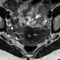 Bicornuate uterus (Radiopaedia 61974-70046 Axial T2 5).jpg