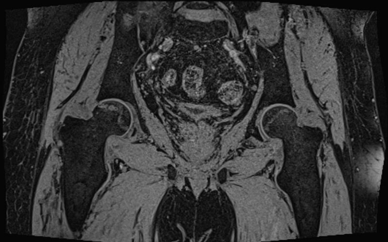 File:Bilateral avascular necrosis of femoral head (Radiopaedia 77116-89078 Coronal T2 we 26).jpg