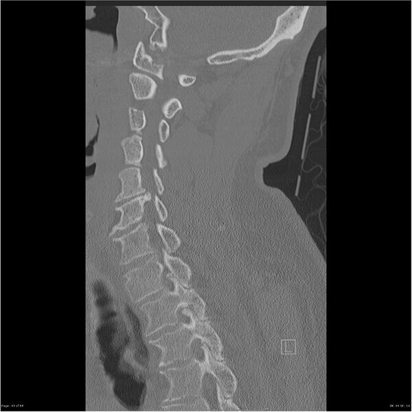 File:Bilateral cervical ribs (Radiopaedia 25868-26017 Sagittal bone window 43).jpg