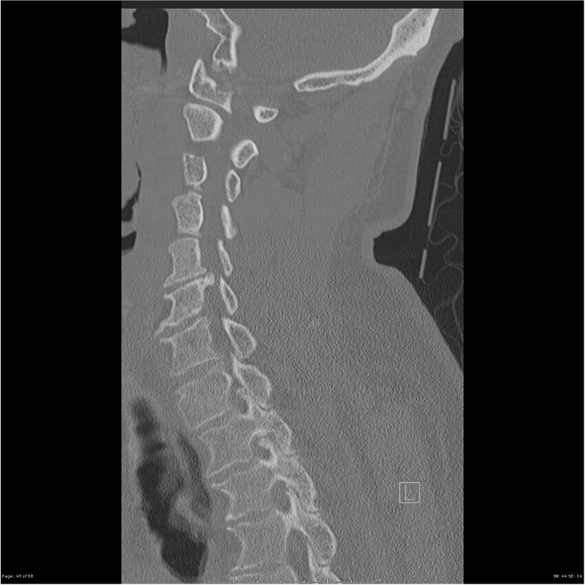 Bilateral cervical ribs (Radiopaedia 25868-26017 Sagittal bone window 43).jpg