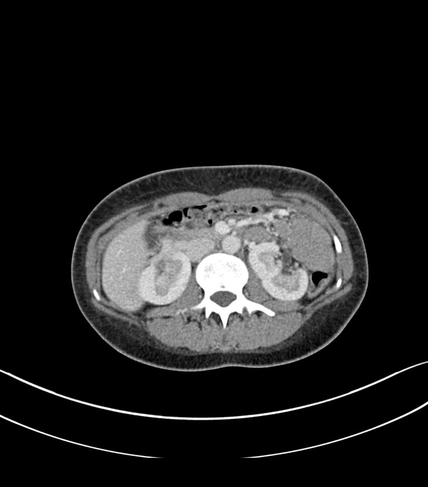 Bilateral kidney malrotation (Radiopaedia 72227-82749 A 21).jpg