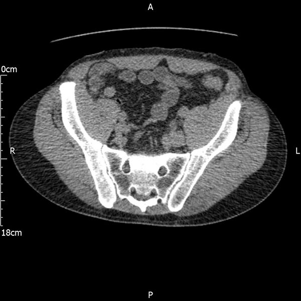 File:Bilateral medullary nephrocalcinosis with ureteric calculi (Radiopaedia 71269-81569 Axial non-contrast 102).jpg