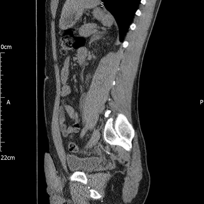 Bilateral medullary nephrocalcinosis with ureteric calculi (Radiopaedia 71269-81569 C 48).jpg