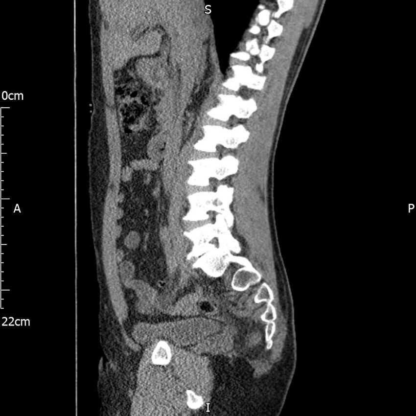 Bilateral medullary nephrocalcinosis with ureteric calculi (Radiopaedia 71269-81569 C 69).jpg