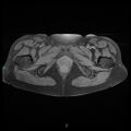 Bilateral ovarian fibroma (Radiopaedia 44568-48293 Axial T1 fat sat 28).jpg