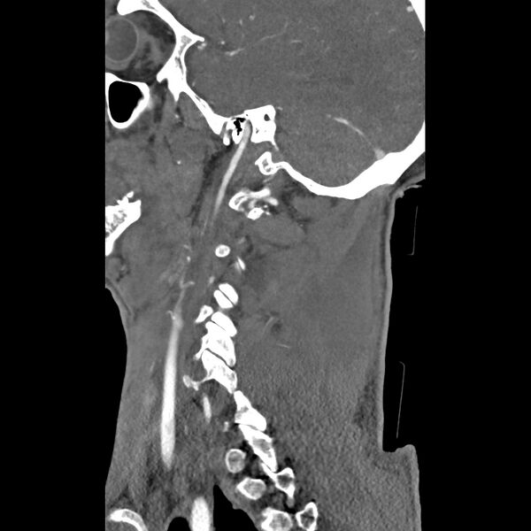 File:Bilateral perched facets with cord injury (Radiopaedia 45587-49713 B 39).jpg