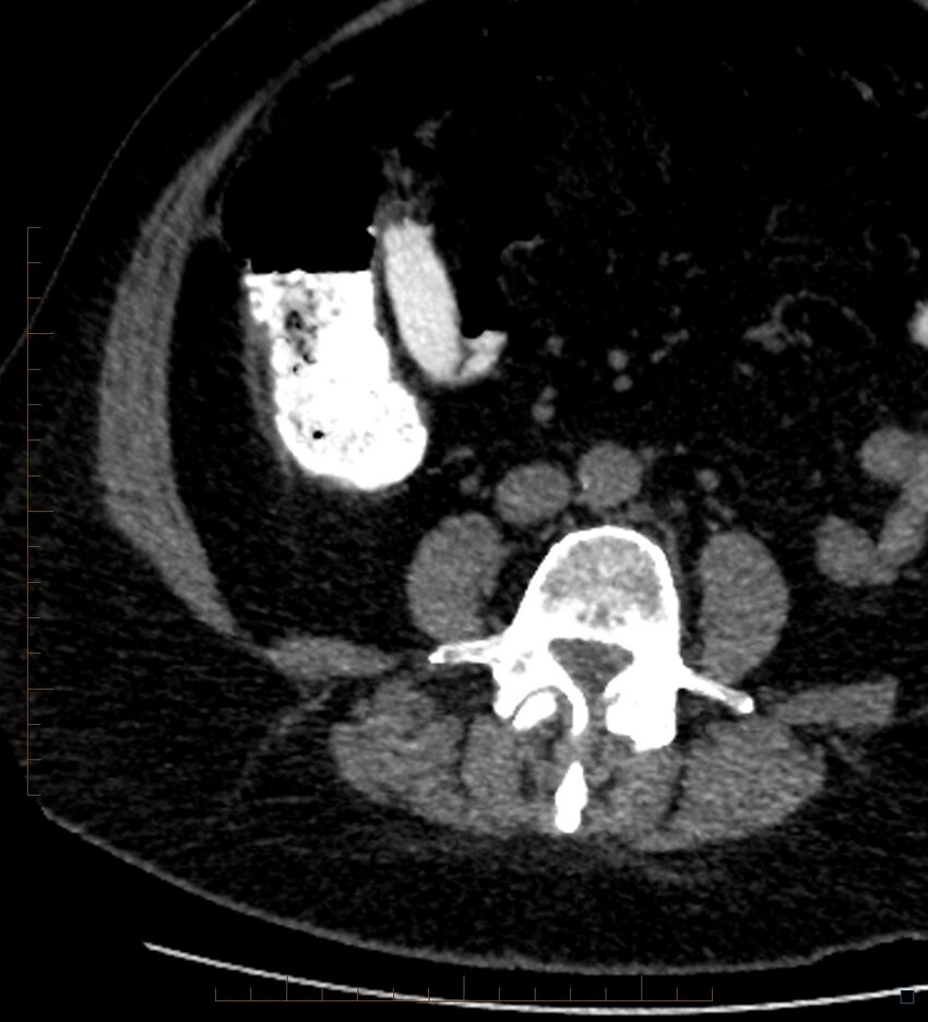 Bile leak from accessory duct(s) of Luschka post cholecystectomy (Radiopaedia 40736-43389 A 68).jpg