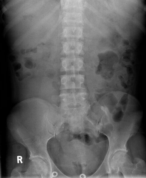 File:Biliary necrosis - liver transplant (Radiopaedia 21876-21841 A 1).jpg