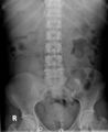 Biliary necrosis - liver transplant (Radiopaedia 21876-21841 A 1).jpg