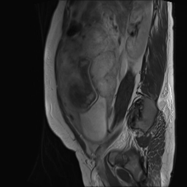 File:Bilobed placenta accreta (Radiopaedia 69648-79591 Sagittal T2 10).jpg