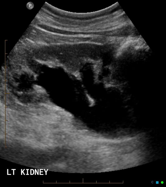 File:Bladder prolapse into vagina (Radiopaedia 18073-17849 B 1).jpg