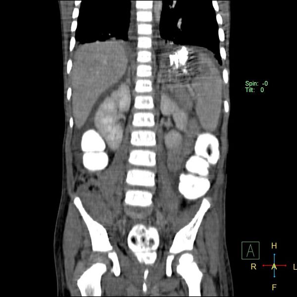 File:Blunt abdominal trauma (Radiopaedia 24780-25044 C 14).jpg