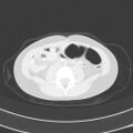 Bochdalek diaphragmatic hernia (Radiopaedia 38866-41059 Axial lung window 35).jpg