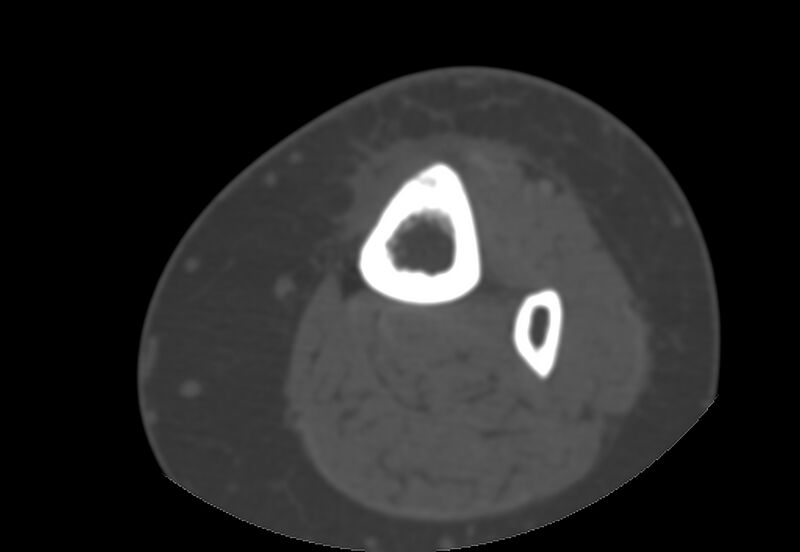 File:Bone metastasis - tibia (Radiopaedia 57665-64609 Axial bone window 16).jpg