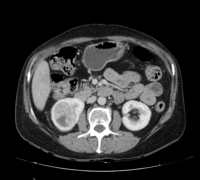 File:Bosniak renal cyst - type IV (Radiopaedia 22929-22953 C 24).jpg