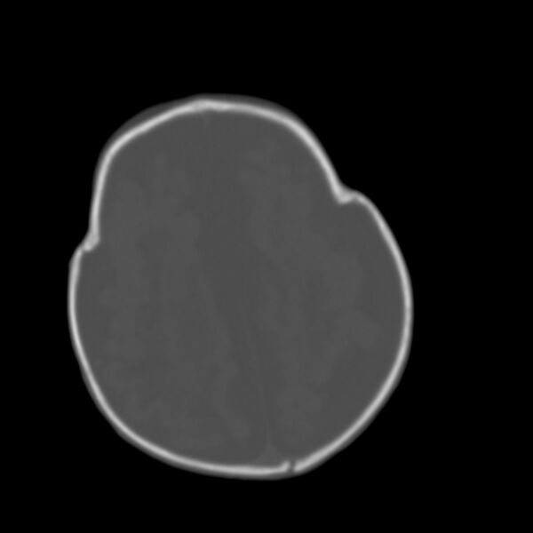 File:Brachycephaly (bi-coronal and bi-lambdoid synostosis) (Radiopaedia 55048-61413 Axial bone window 17).jpg