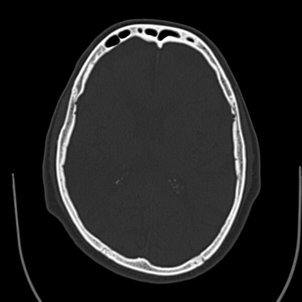 File:Brain Pantopaque remnants (Radiopaedia 78403-91048 Axial bone window 41).jpg