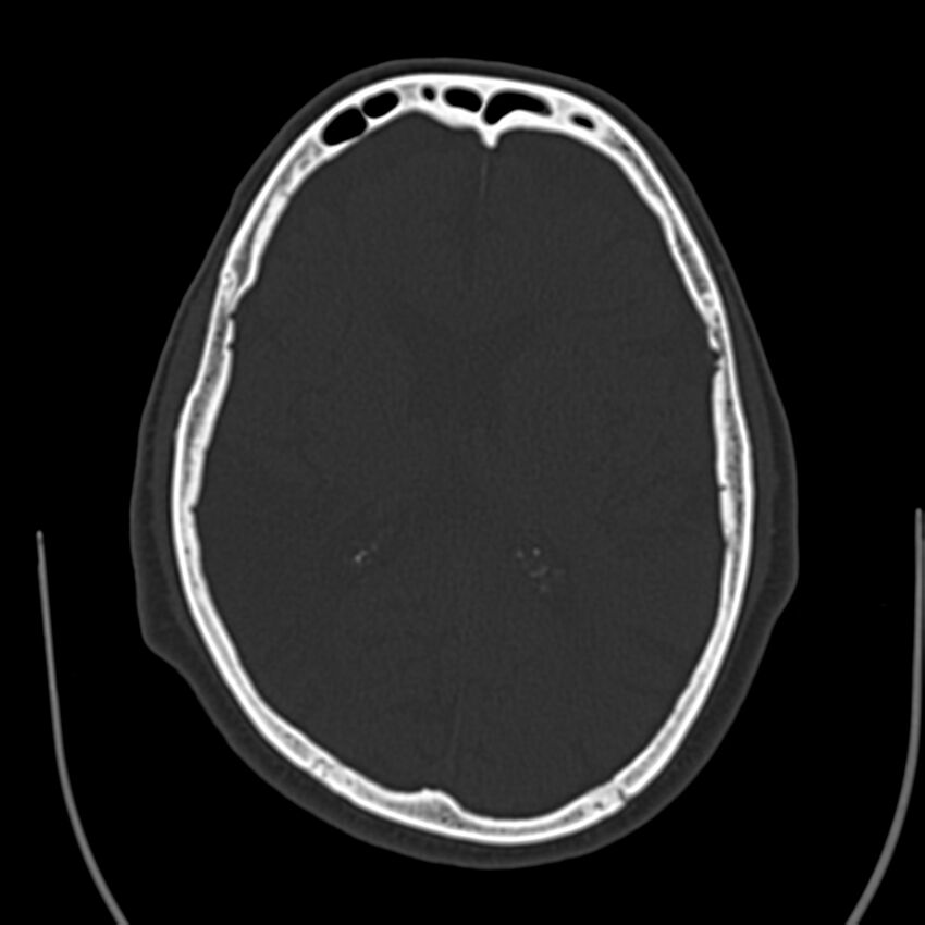 Brain Pantopaque remnants (Radiopaedia 78403-91048 Axial bone window 41).jpg