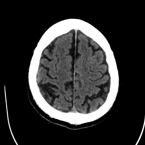 File:Brain Pantopaque remnants (Radiopaedia 78403-91048 Axial non-contrast 72).jpg