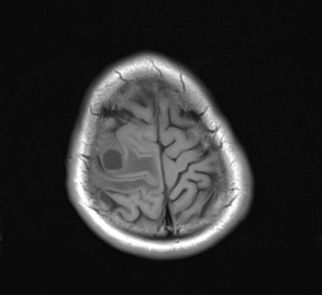 File:Brain metastases - lung cancer primary (Radiopaedia 75060-86115 Axial T1 22).jpg