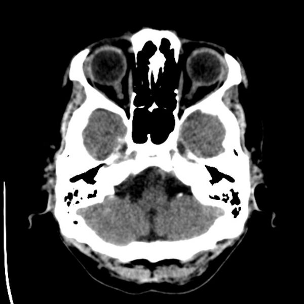 File:Brain metastases from lung cancer (Radiopaedia 24480-24781 Axial non-contrast 6).jpg