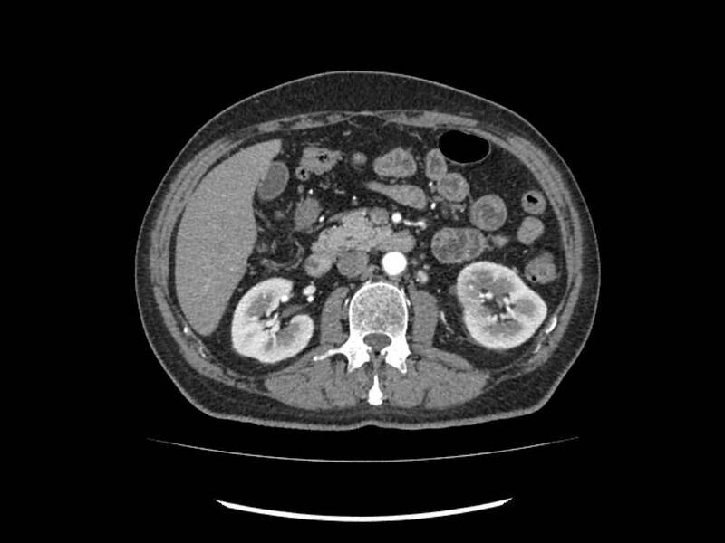 File:Brain metastases from renal cell carcinoma (Radiopaedia 42222-45328 A 97).jpg