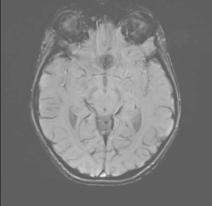 Brainstem glioma (Radiopaedia 70548-80674 Axial SWI 27).jpg