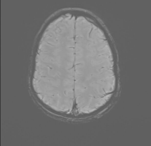 File:Brainstem glioma (Radiopaedia 70548-80674 Axial SWI 51).jpg