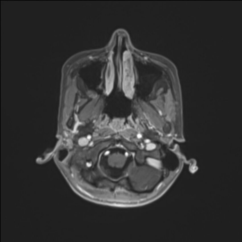 Brainstem glioma (Radiopaedia 70548-80674 Axial T1 C+ 23).jpg