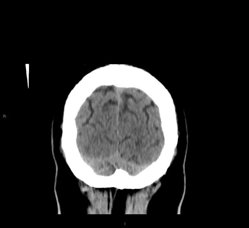 Brainstem hemorrhage (Radiopaedia 58794-66028 Coronal non-contrast 10).jpg