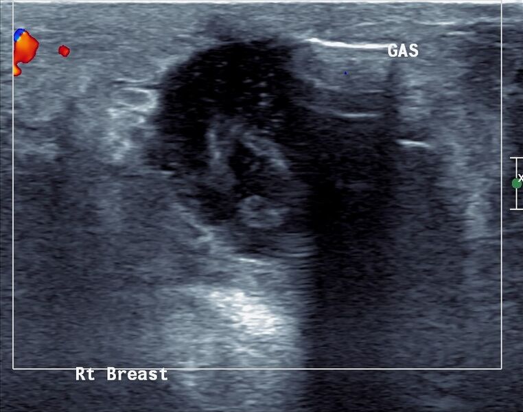 File:Breast abscess (Radiopaedia 55347-61769 E 1).jpg