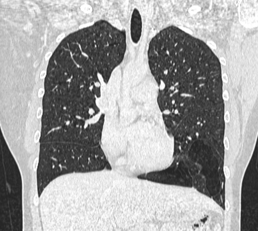 Bronchial atresia (Radiopaedia 50007-55297 Coronal lung window 43).jpg