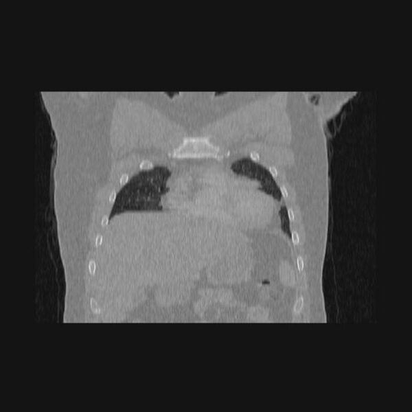 File:Bronchial atresia (Radiopaedia 60685-68439 Coronal lung window 59).jpg