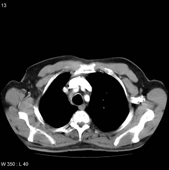 File:Bronchial carcinoid tumor with right lower lobe collapse (Radiopaedia 29060-29422 A 12).jpg