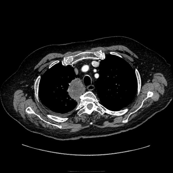File:Bronchogenic adenocarcinoma and pulmonary embolism (Radiopaedia 9097-9806 D 18).jpg