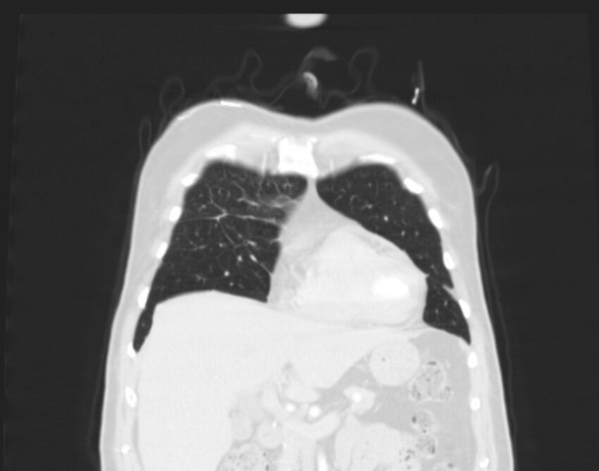 Bronchogenic carcinoma with lymphangitic spread (Radiopaedia 29002-29357 Coronal lung window 11).jpg