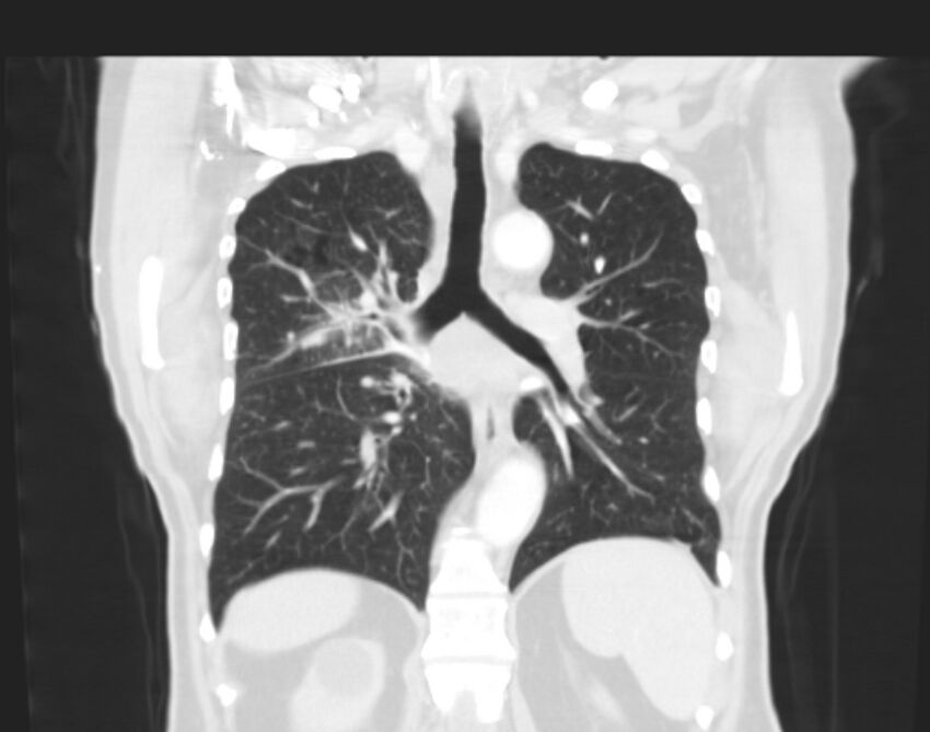 Bronchogenic carcinoma with lymphangitic spread (Radiopaedia 29002-29357 Coronal lung window 44).jpg