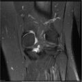 Bucket handle tear - lateral meniscus (Radiopaedia 7246-8187 Coronal T2 fat sat 6).jpg