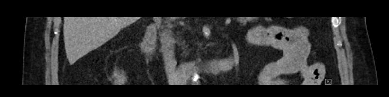 File:Buried bumper syndrome - gastrostomy tube (Radiopaedia 63843-72575 Coronal Inject 48).jpg